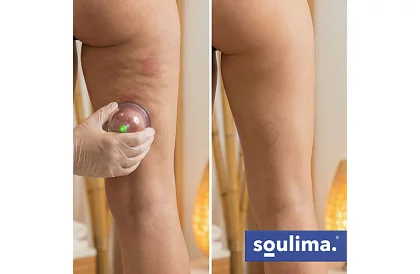 Zestaw chińskich baniek do bańkowania bez ognia – 12 sztuk